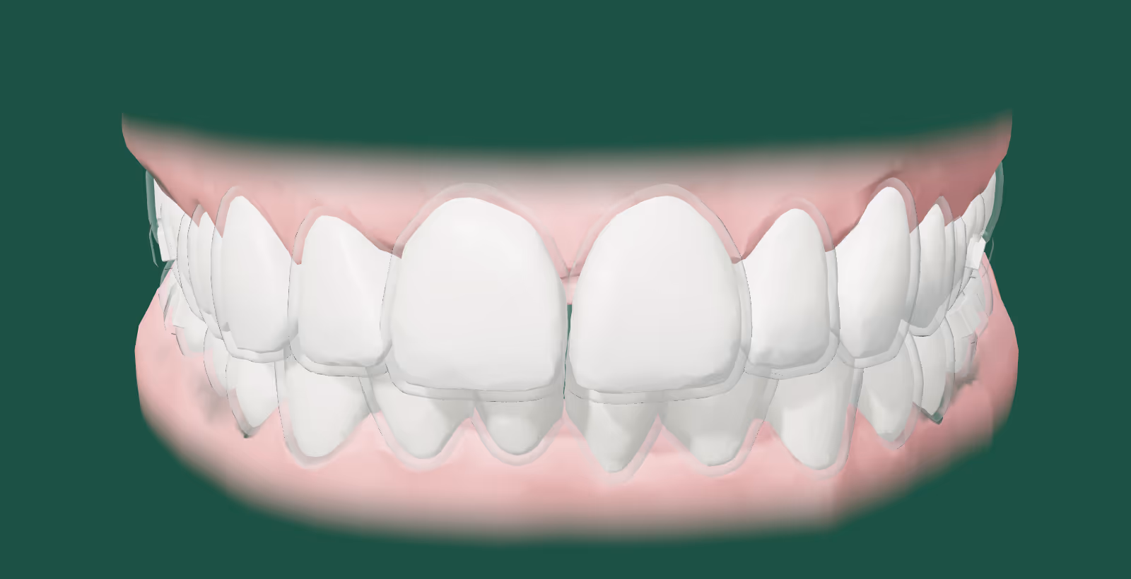 Arcada real com alinhador transparente. Antes: os dentes como estavam no exame.