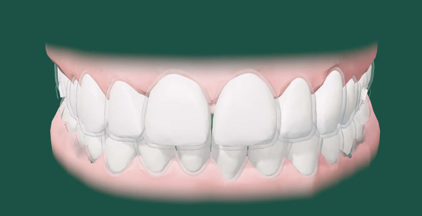 Arcada real com alinhador transparente. Com o 1º alinhador, os dentes da frente começam a andar.