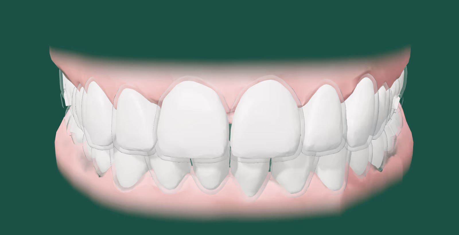 Arcada real com alinhador transparente. Com o 2º alinhador, cada dente anda mais um pouco.